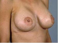 Breast augmentation lift before & after photo