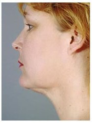 Neck liposuction before & after photo