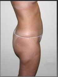Vaserlipo before & after photo