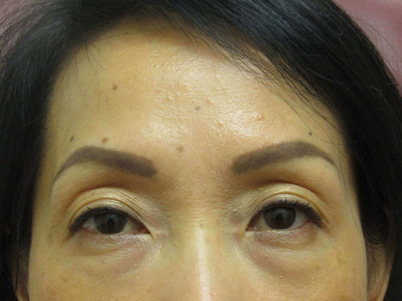 Botox before & after photo
