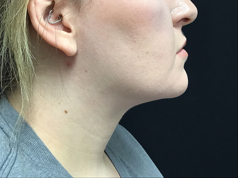 Liposuction & neck tightening after