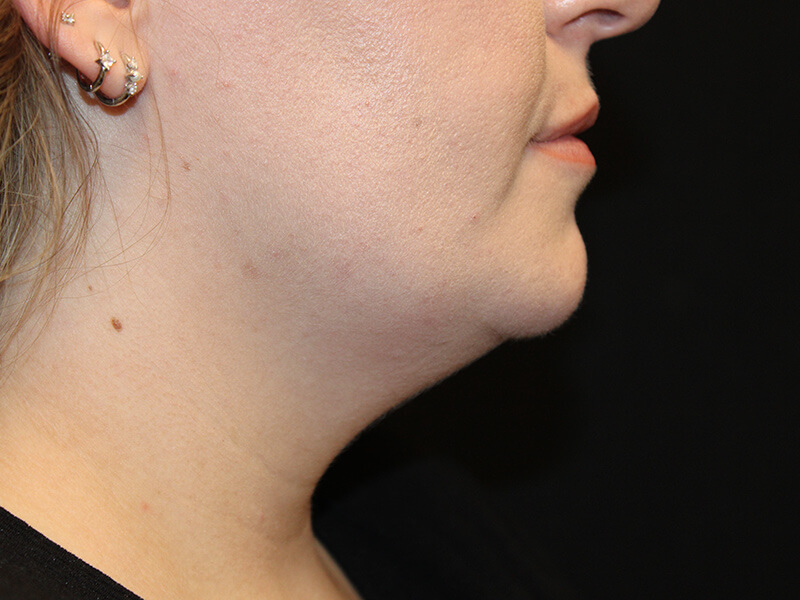 Liposuction & neck tightening before