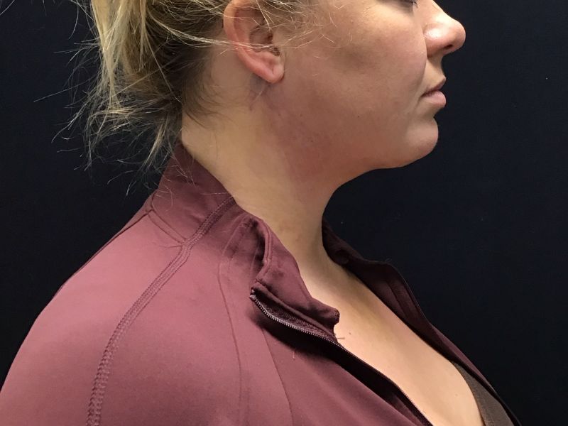 Liposuction & neck tightening after