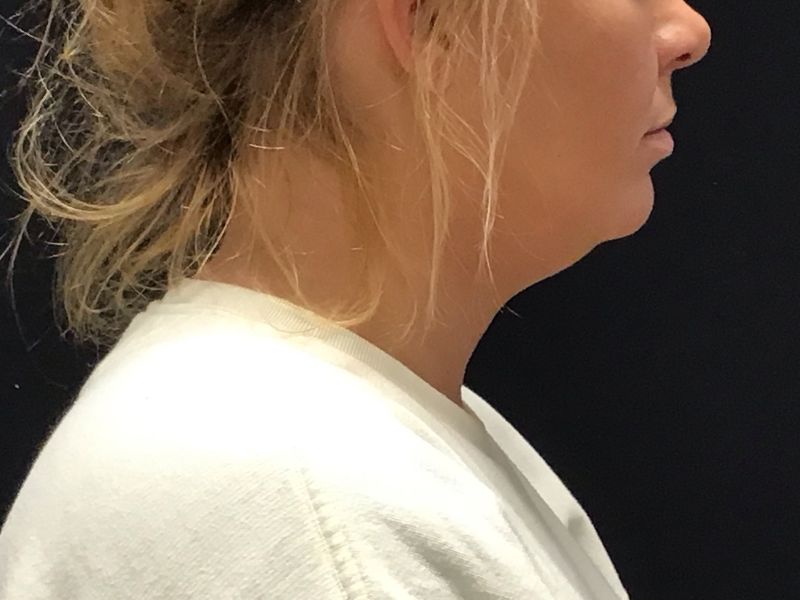 Liposuction & neck tightening before