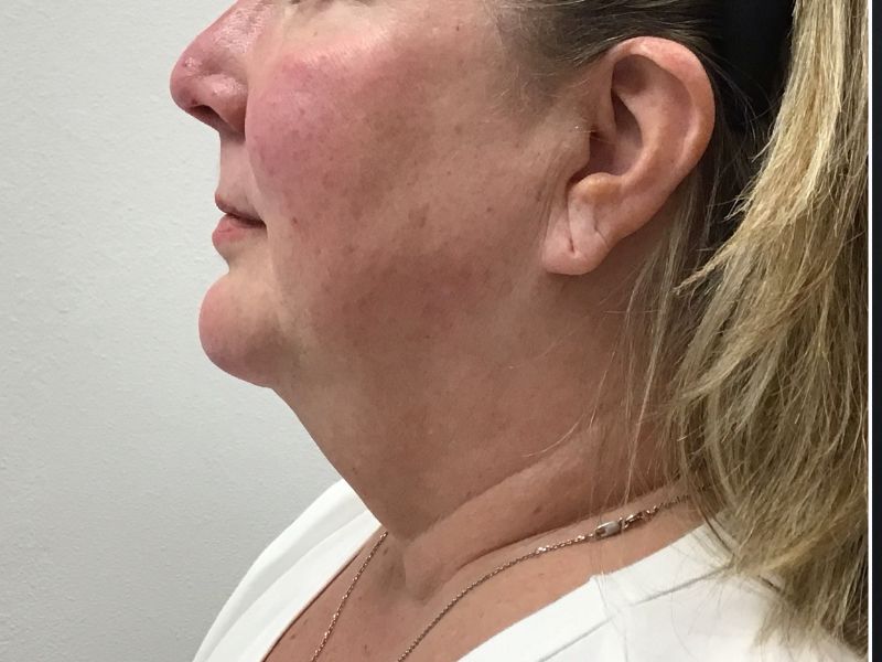 Liposuction & neck tightening before