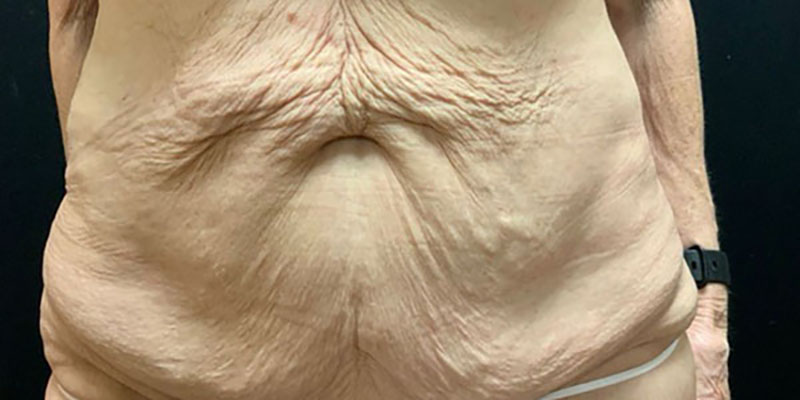 Wwl before & after photo