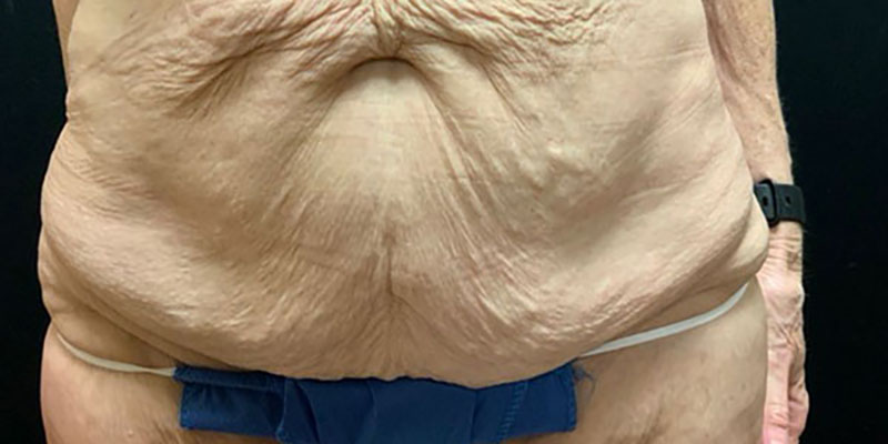 Wwl before & after photo