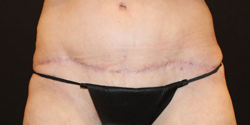 Wwl before & after photo