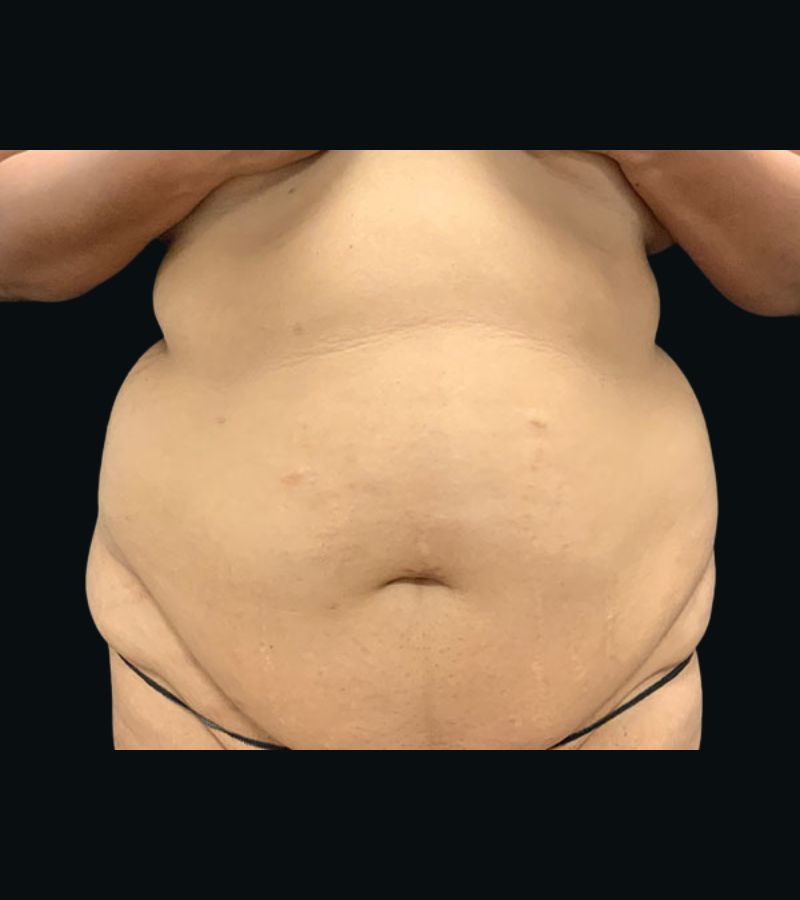 Wwl before & after photo