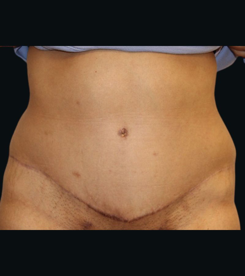 Wwl before & after photo