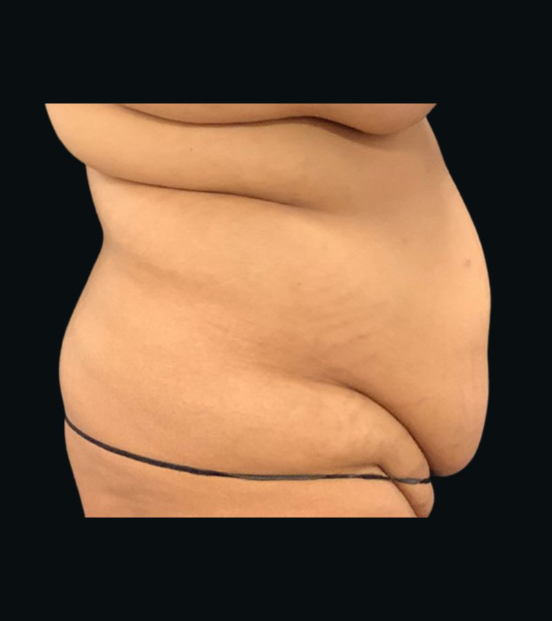 Wwl before & after photo