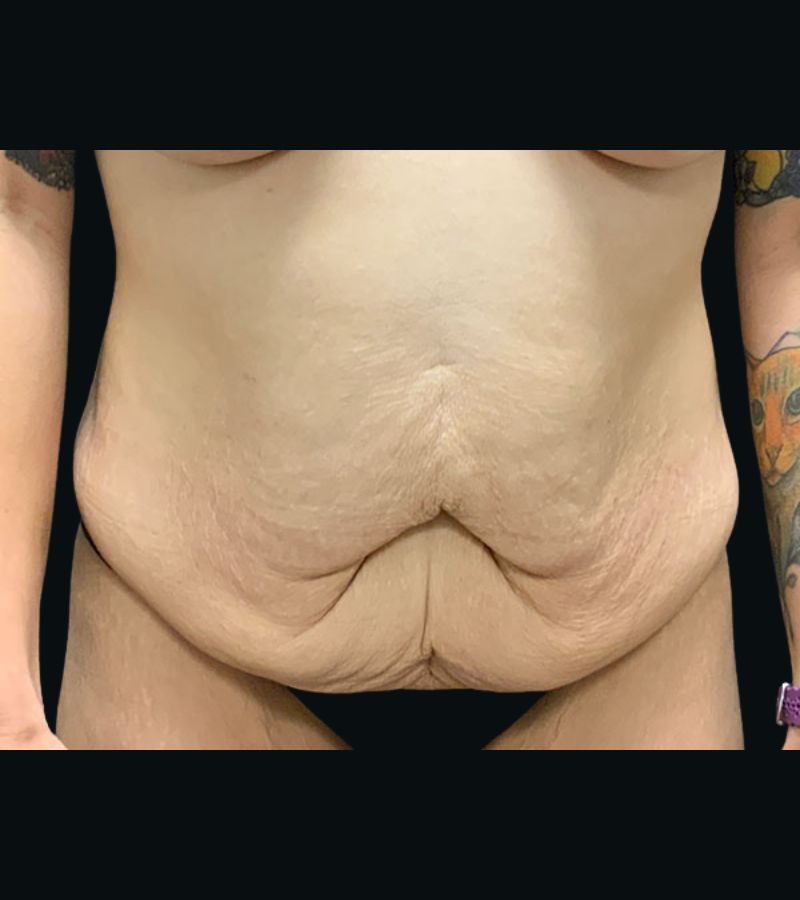 Wwl before & after photo