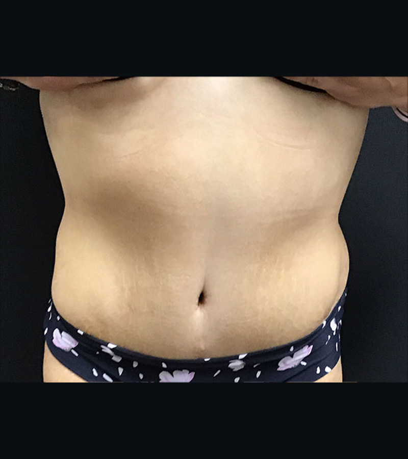 Wwl before & after photo