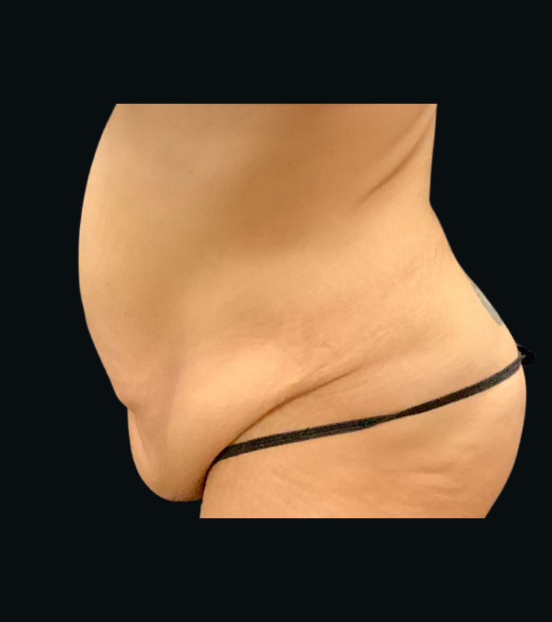 Wwl before & after photo