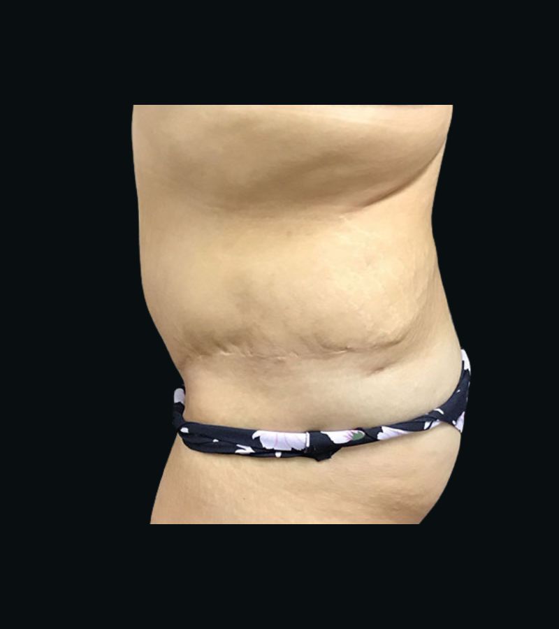 Wwl before & after photo