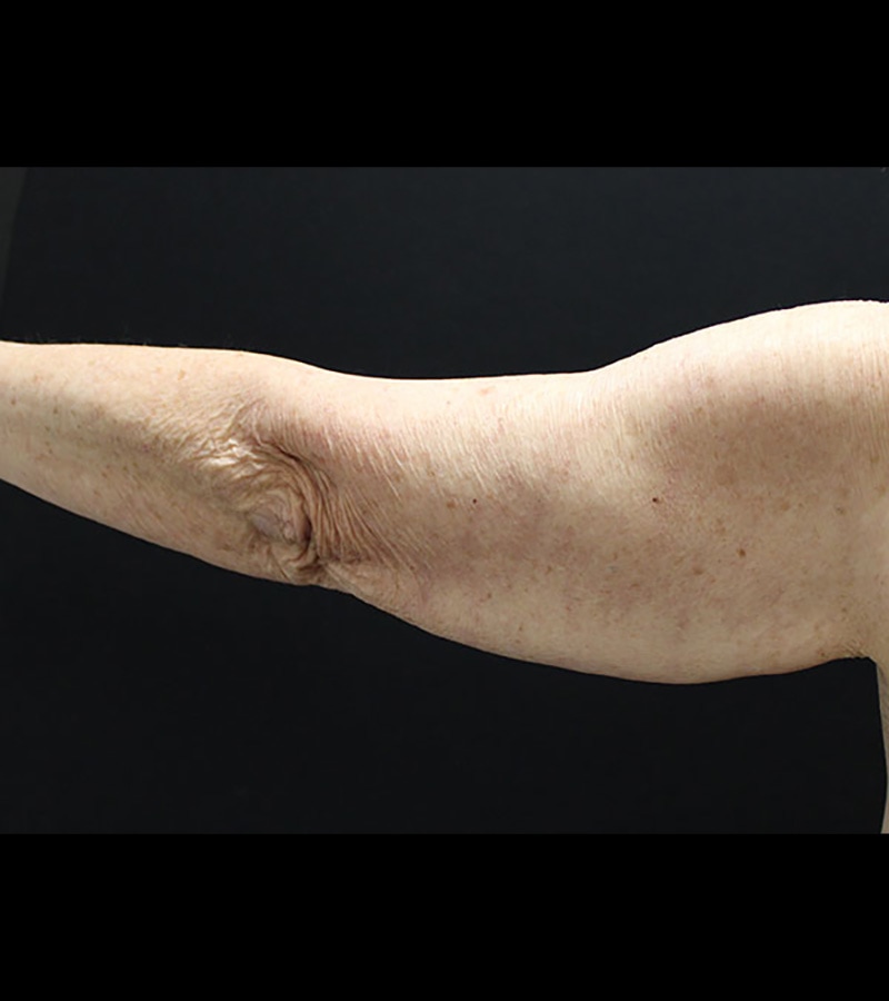 Wwl before & after photo