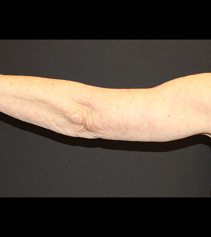 Wwl before & after photo