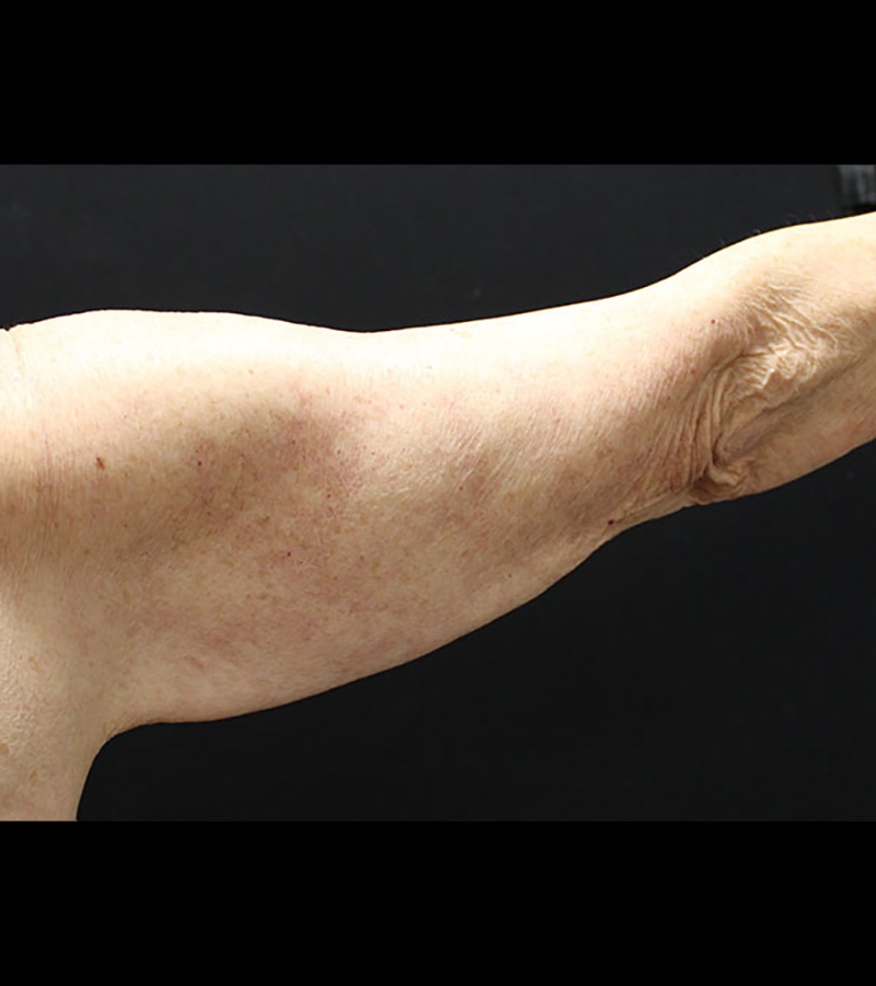 Wwl before & after photo