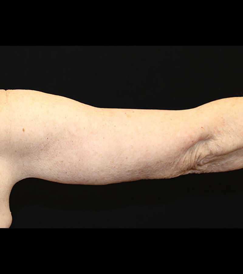 Wwl before & after photo