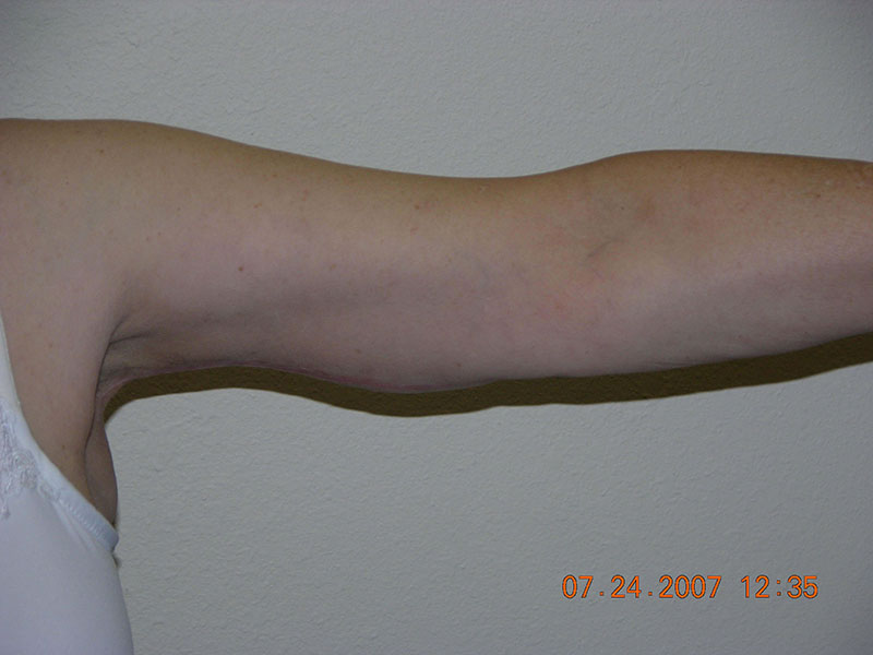 Arm lift before & after photo