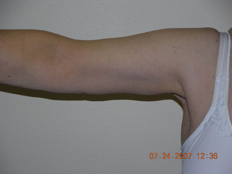 Arm lift before & after photo