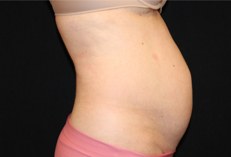 Liposuction before & after photo