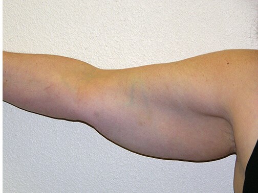 Liposuction before & after photo