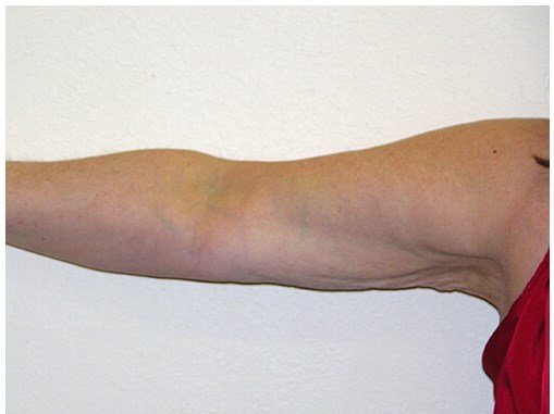 Liposuction before & after photo