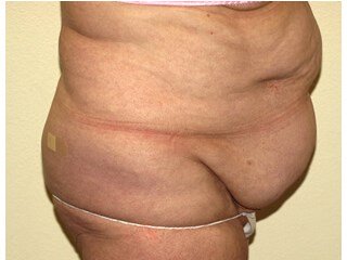 Liposuction before & after photo