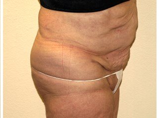 Liposuction before & after photo