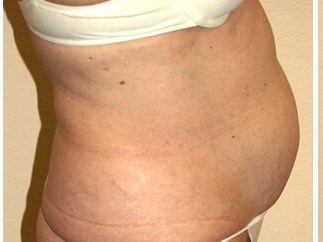 Liposuction before & after photo