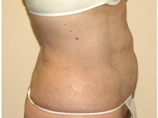 Liposuction before & after photo