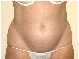 Liposuction before & after photo