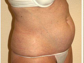 Liposuction before & after photo