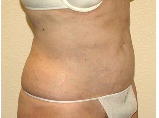 Liposuction before & after photo