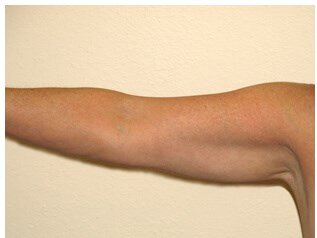 Liposuction before & after photo