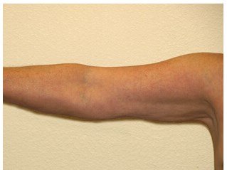 Liposuction before & after photo