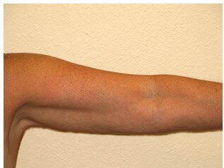 Liposuction before & after photo
