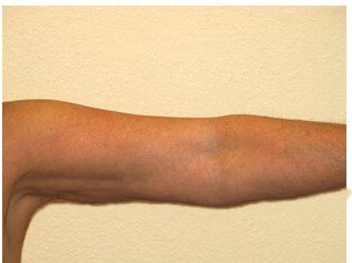 Liposuction before & after photo