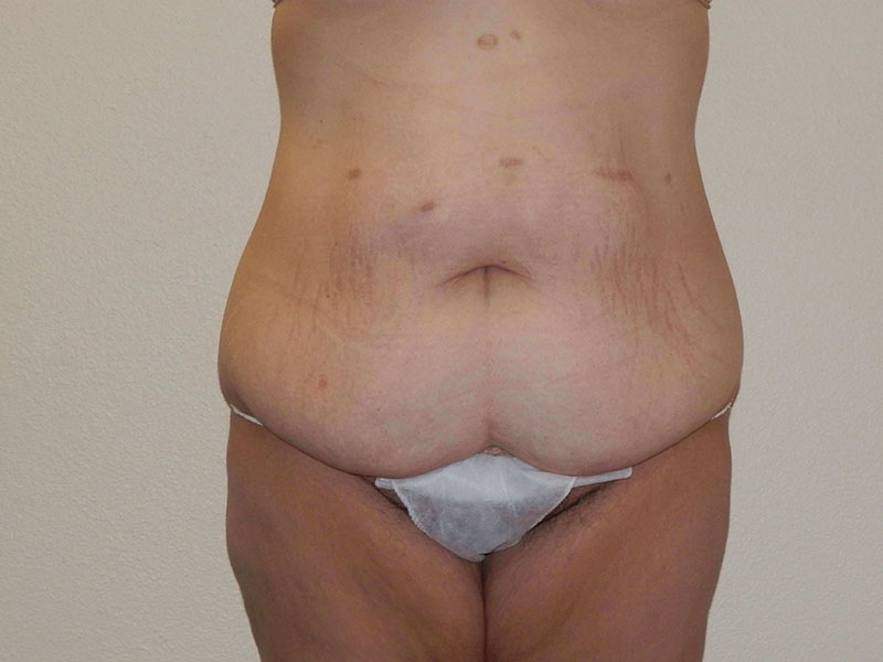 Thigh lift before & after photo