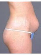 Tummy tuck before & after photo