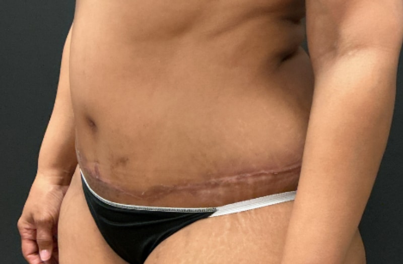 Tummy tuck before & after photo