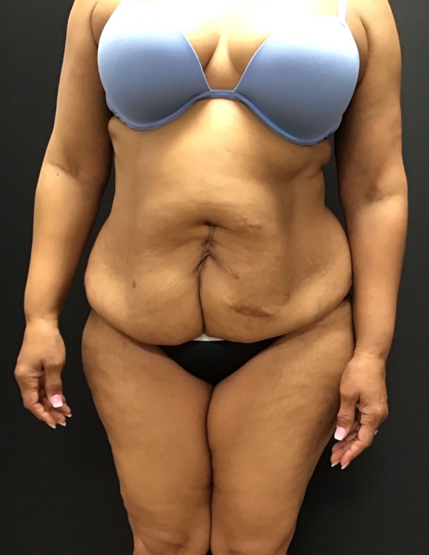 Tummy tuck before & after photo