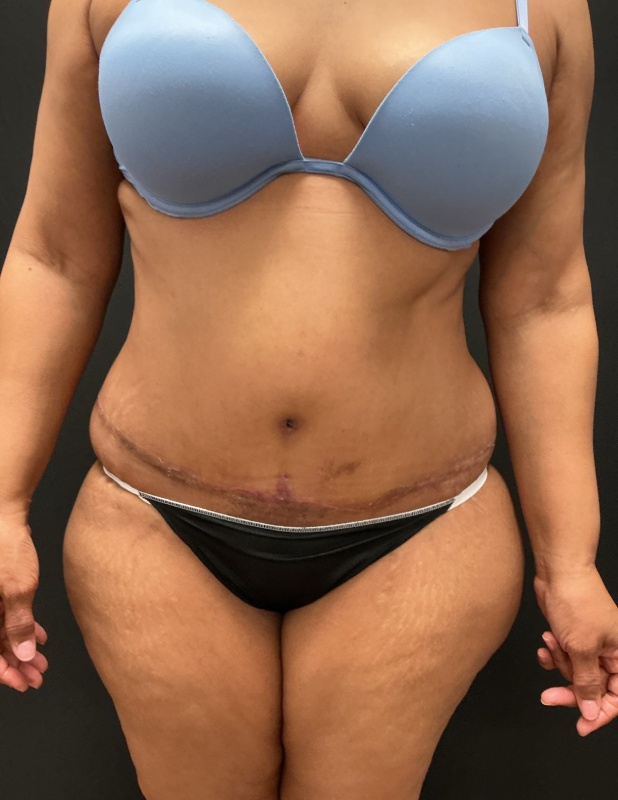 Tummy tuck before & after photo