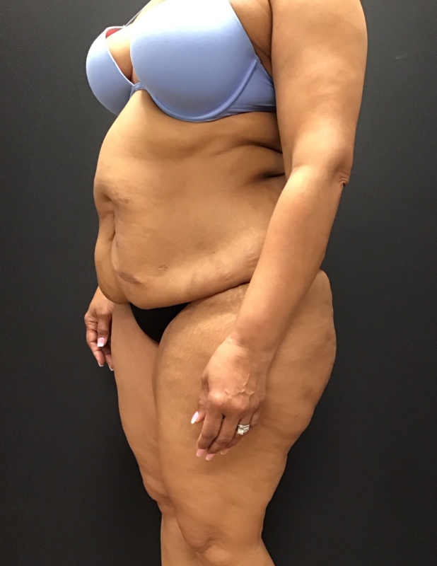 Tummy tuck before & after photo