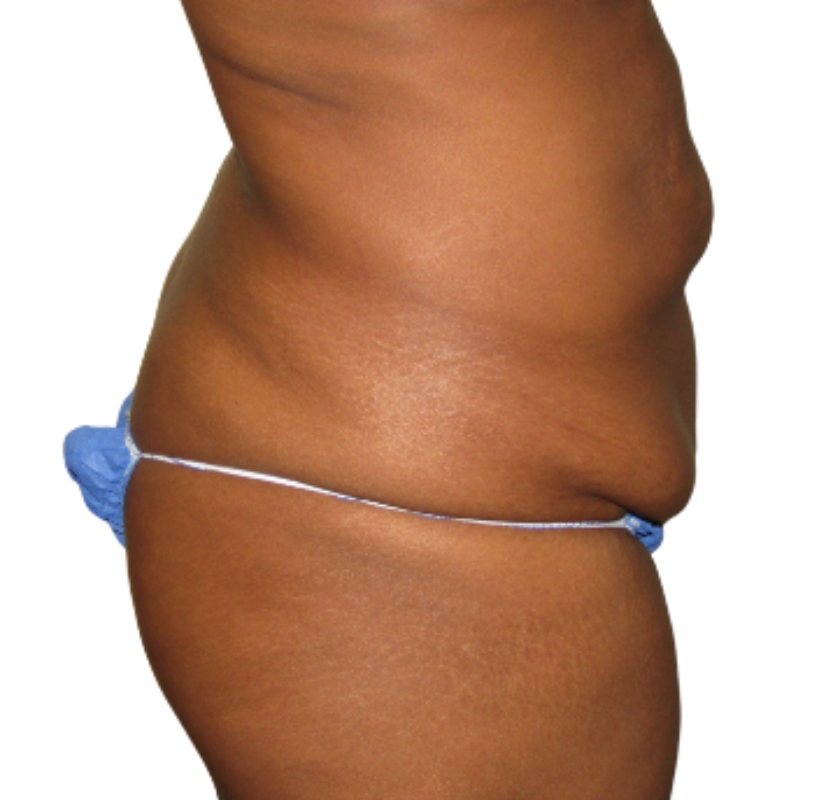 Tummy tuck before & after photo