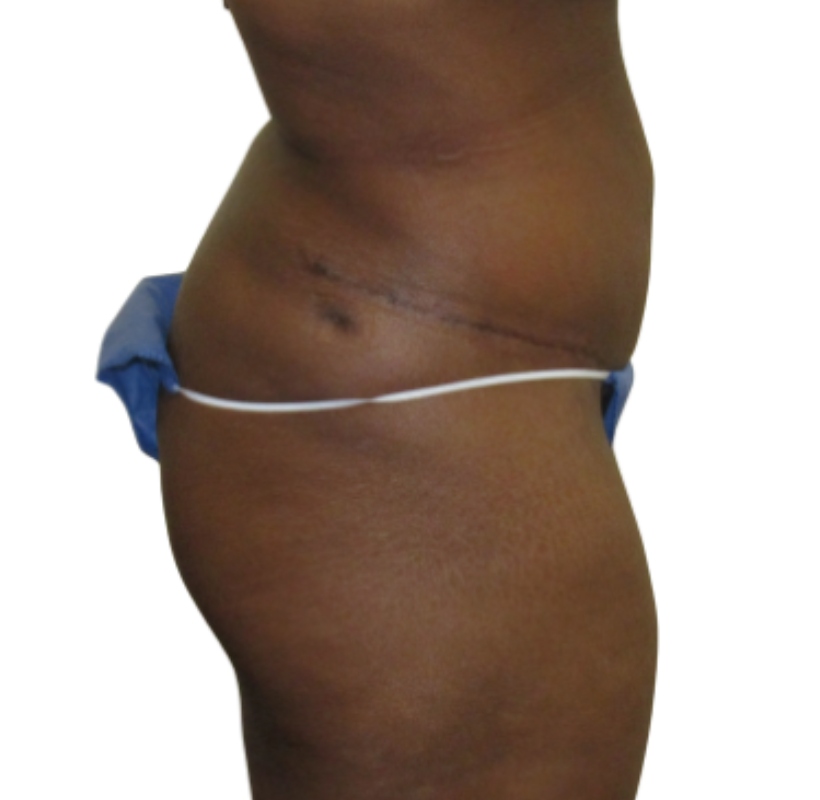 Tummy tuck before & after photo
