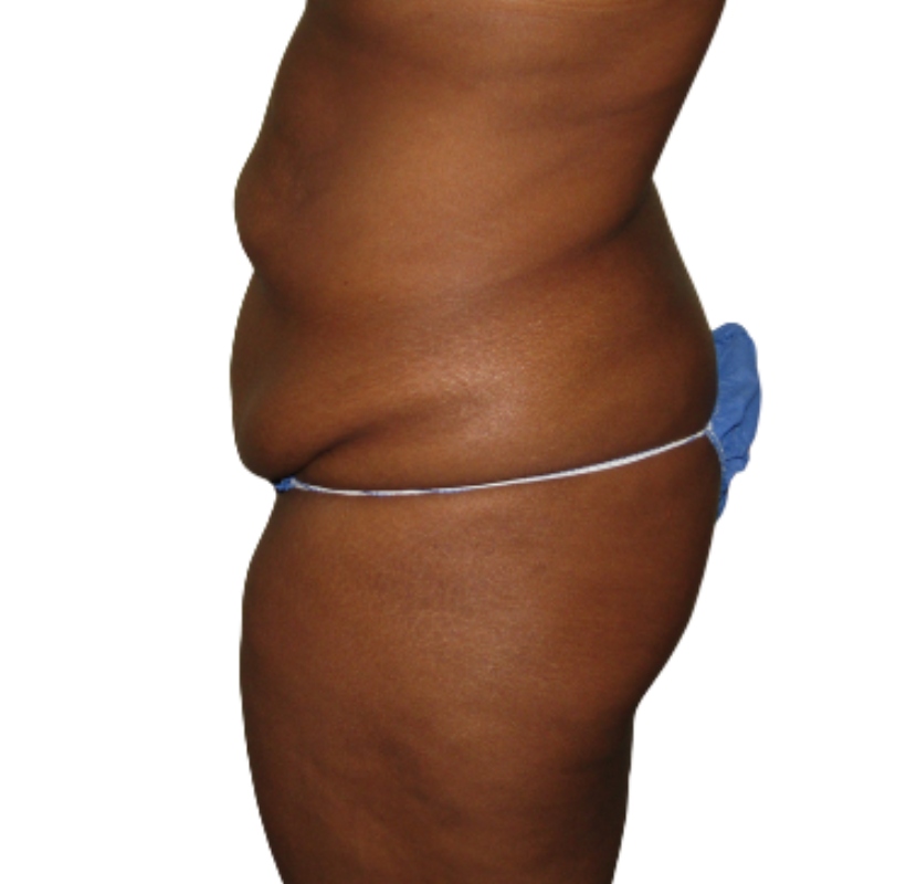 Tummy tuck before & after photo