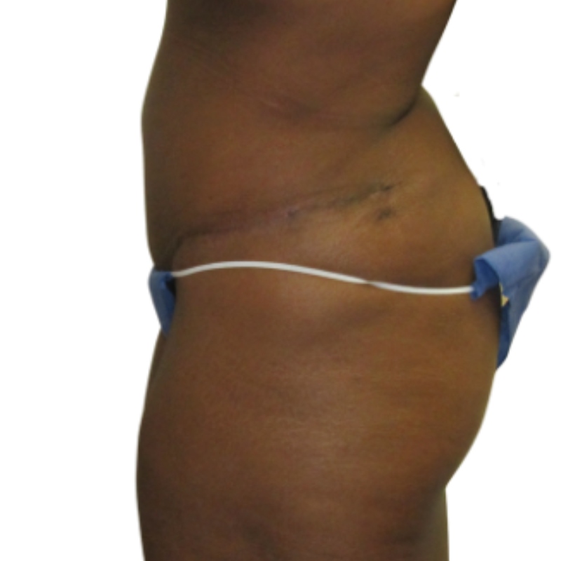 Tummy tuck before & after photo