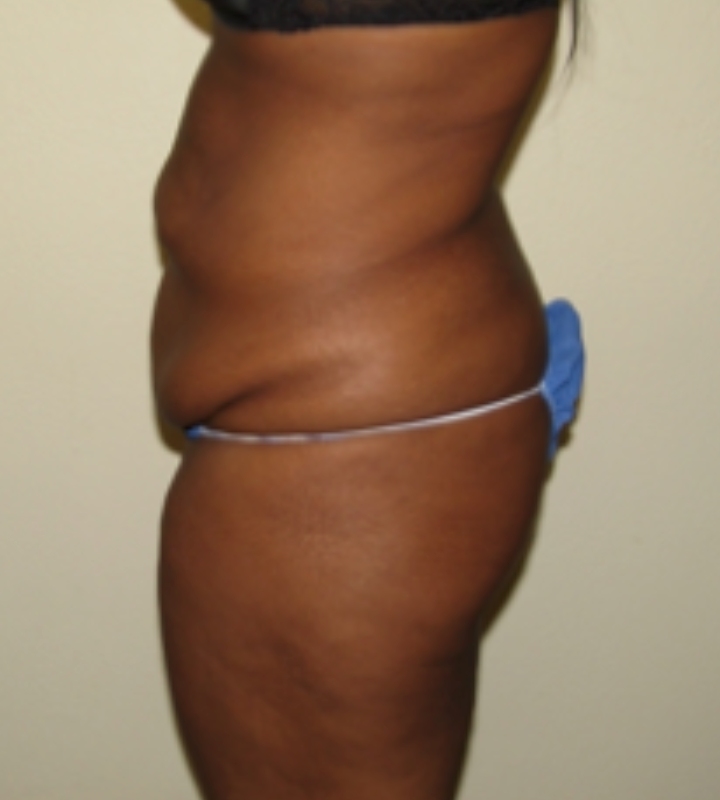 Tummy tuck before & after photo